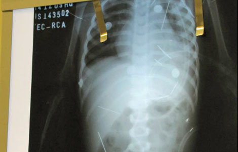 La radiografía del cuerpo del niño de dos años.| Efe