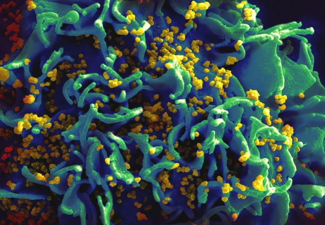 Imagen de partículas de VIH infectando una célula T humana.