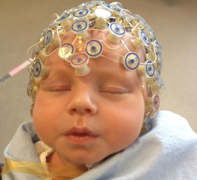 Un bebé dormido con electrodos en la cabeza.
