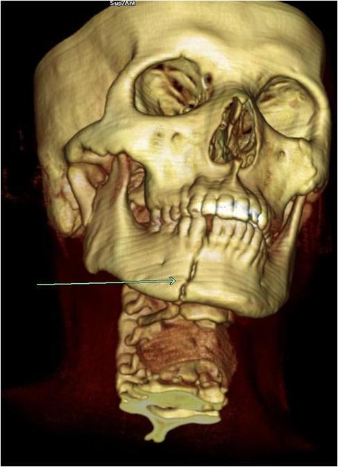 Una autopsia digital que muestra una fractura en la mandbula. IGENE