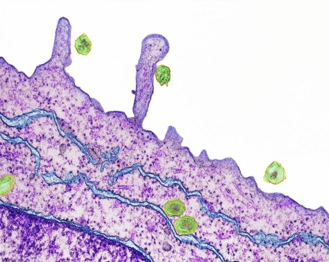 Virus de la hepátitis C (en verde), infectando células del hígado.