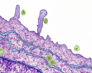 Virus de la heptitis C (en verde), infectando clulas del hgado.