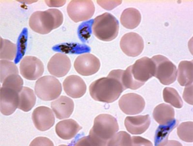 En azul, el Plasmodium falciparum. En rojo, hemates no infectados.