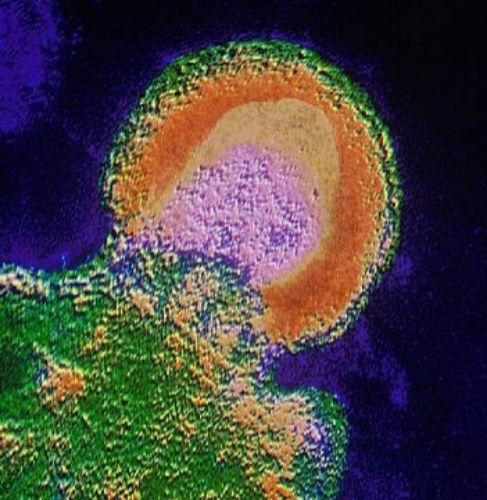 Un linfocito infectado por el virus del VIH