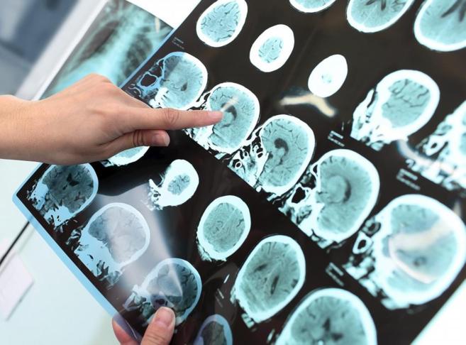 Una doctora examina un tomograma de un paciente con Alzheimer.