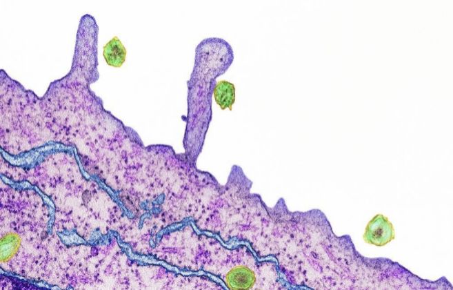 Virus de la heptitis C (en verde), infectando clulas del hgado
