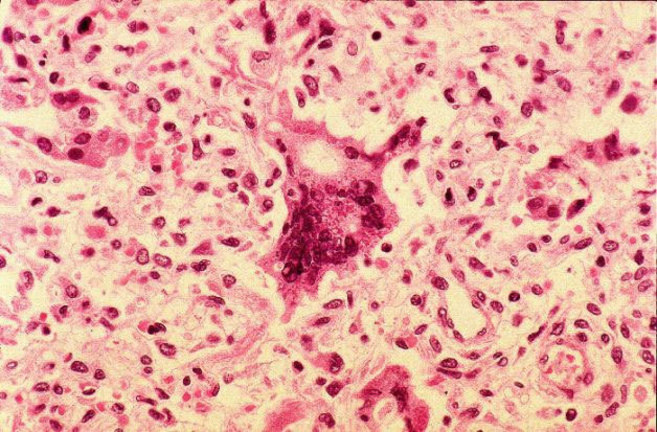 Clulas infectadas por el virus del sarampin.