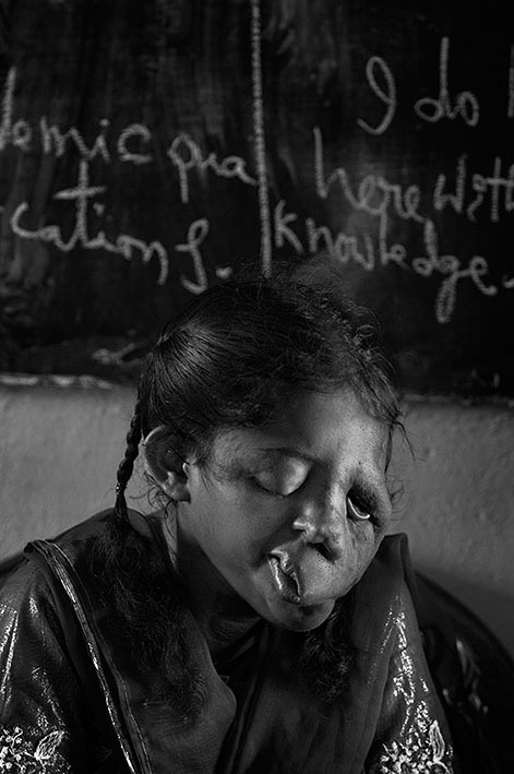 <strong>Hospital Gubernamental de Kabir Choura - Varanasi (Uttar Pradesh)</strong>. El Hospital gubernamental Kabir Choura, en Varanasi, dispone de 15 camas en la Unidad de Quemados. La mayora de los pacientes que acuden son mujeres jvenes, casadas y cuyos maridos o sus familias queman con queroseno para presionar a los suegros en la entrega de la dote o para casarse nuevamente con otra mujer. Es lo que se conoce como "quema de novias". La mayora de estos crmenes se registra como accidente domstico.