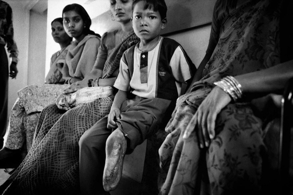 <strong>Familia con discapacidad - Jaipur (Rajasthan)</strong>. La India tiene una de las tasas de discapacidad ms elevadas del mundo, en torno al 5 % de la poblacin. En la fotografa, un matrimonio con discapacidad fsica recibe la nueva prtesis de la mujer.