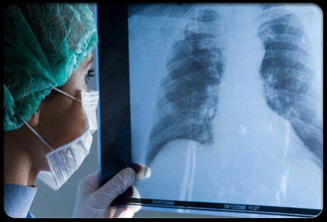 Radiografa de los pulmones.