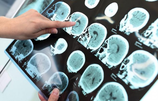 Un especialista examina una tomografía de un paciente con Alzheimer.