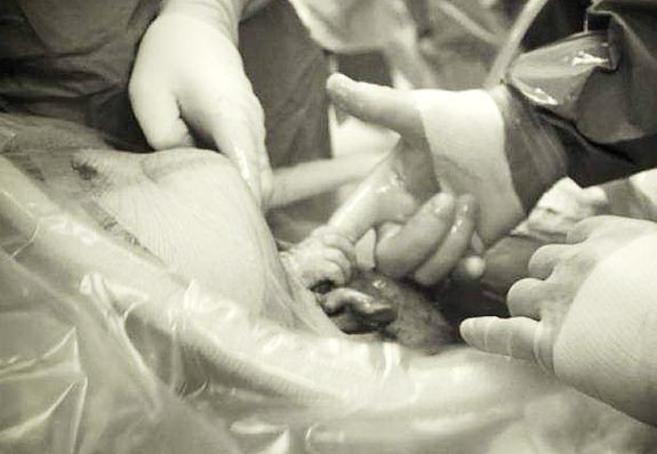 Imagen de archivo de un parto por cesárea.