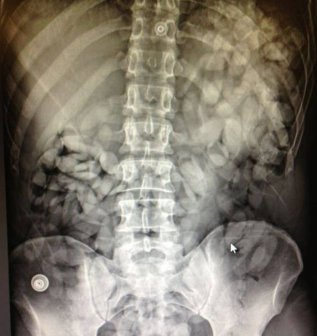 Radiografa del torso del portador de droga.