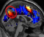 Cerebro de una persona sin autismo (izqda) y otro de un paciente...