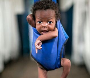 Vasco, un nio de dos meses malnutrido en el Congo.