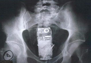 Radiografa de un preso con un telfono introducido por el recto.