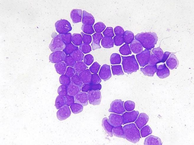 Clulas cancerosas de una enferma con leucemia.