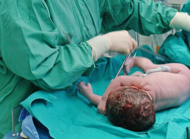 Una matrona atiende a un bebé tras una cesárea.