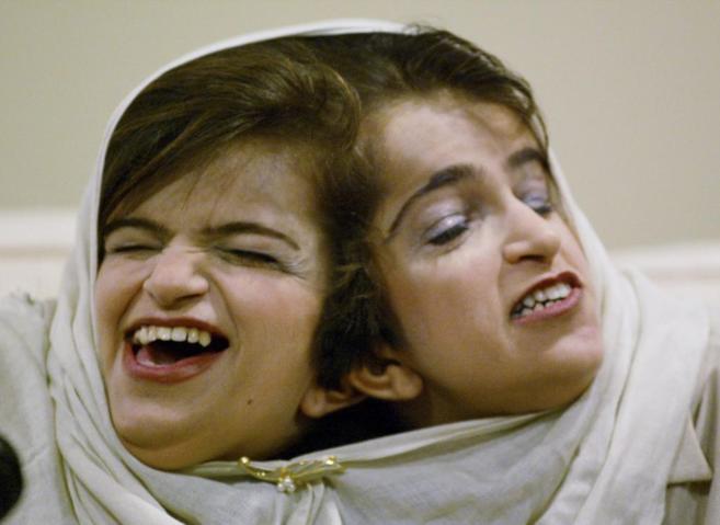 Las siamesas Ladan (izquierda) y Laleh Bifani, que murieron en 2003...