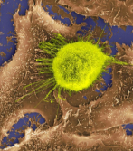 Imagen microscpica de las clulas de un tumor de pulmn.