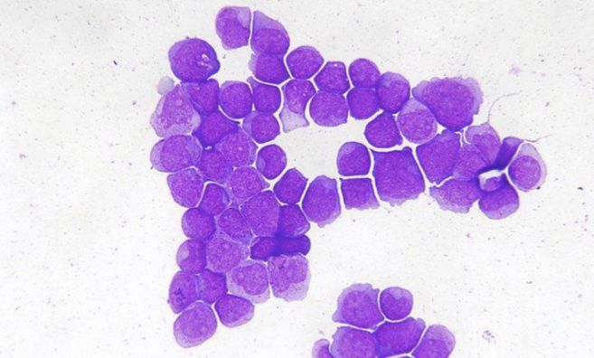 Clulas cancerosas de una paciente con leucemia.