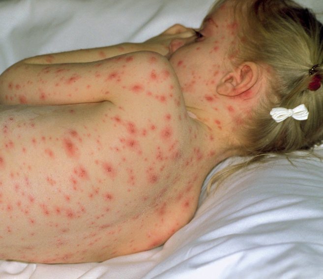 Un nia afectada por la varicela.
