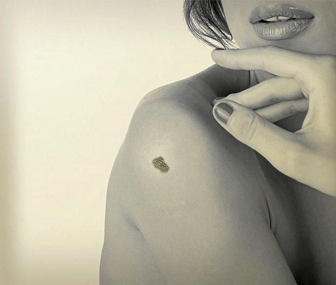 Una mujer con una marca de melanoma.
