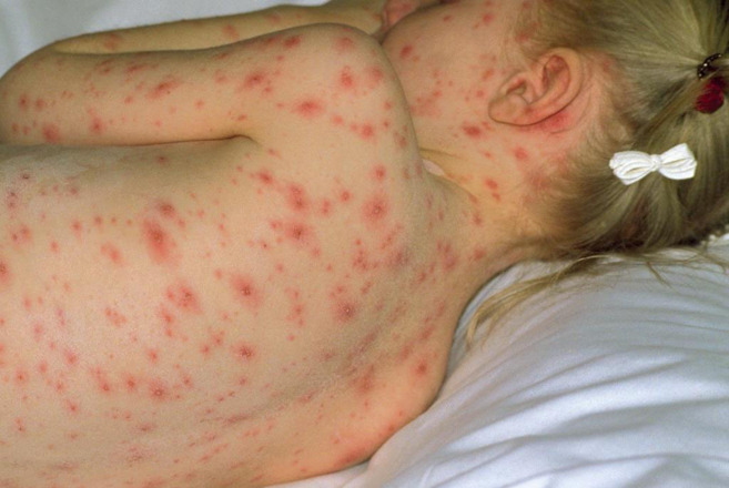 Una niña afectada por varicela.