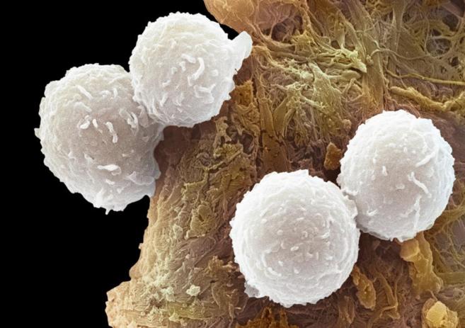 Clulas de un enfermo de leucemia bajo el microscopio.