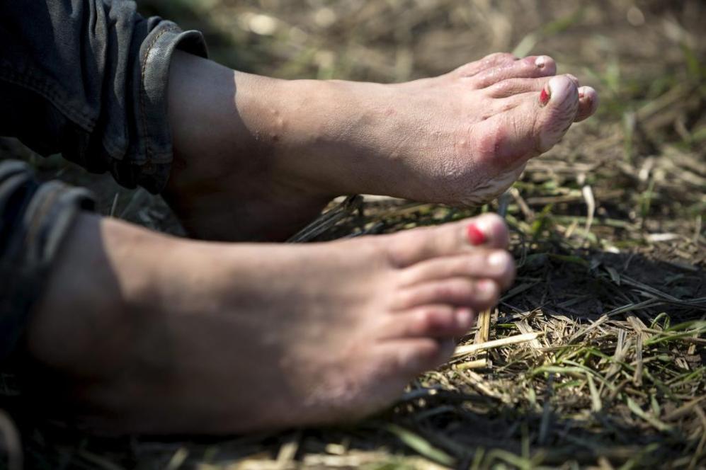 Los pies llenos de heridas de Aya, 17 aos, de origen sirio despus...