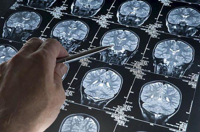 Imgenes cerebrales de una persona afectada por la enfermedad de...