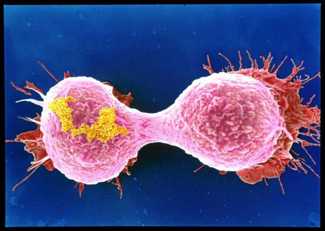 Vista al microscopio de células cancerígenas durante el proceso de...