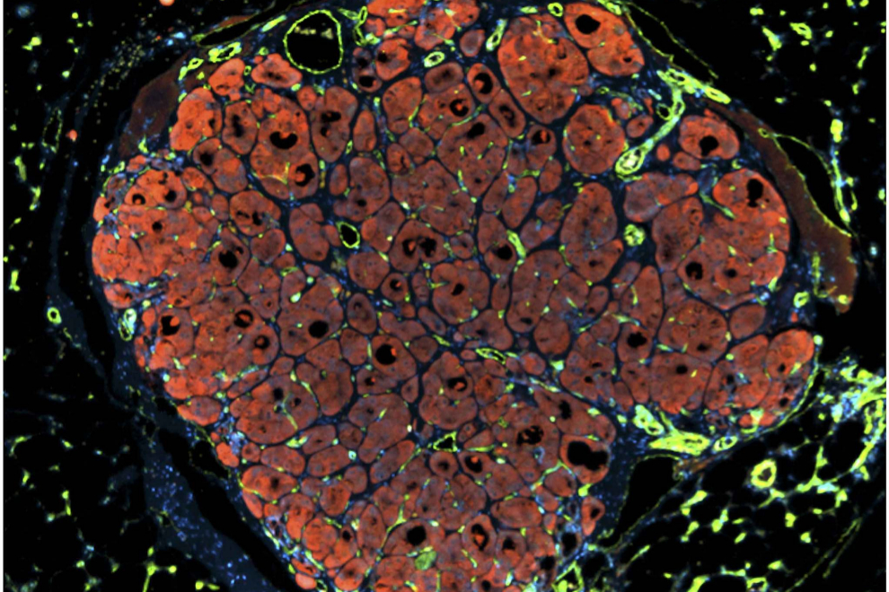 Un pequeo trozo de tejido de un hgado humano se introdujo en un ratn con un hgado daado. Las clulas del hgado humano (en rojo/naranja) y los vasos sanguneos (verde) en el nuevo hgado se han agrupado y comenzado a crecer con la ayuda de la sangre del ratn (blanco).Los investigadores esperan que un da implantes como este se puedan utilizar para reparr hgados daados por cirrosis o cncer.