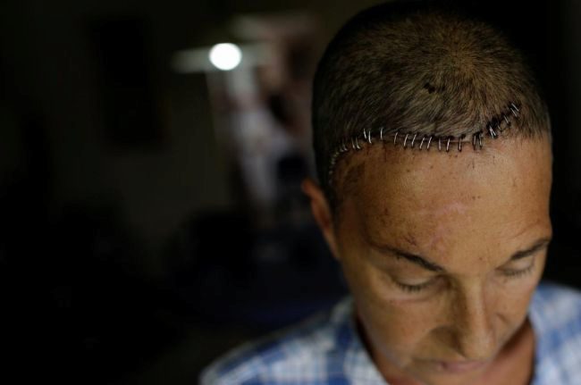 Yolyter Rodriguez, de 56, madre de tres hijos, posa en su casa de Caracas con una herida en la cabeza provocada por el impacto de un cartucho metálico de gas lacrimógeno en su cabeza.