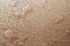 Urticaria, sabaones... El coronavirus tambin ataca a la piel