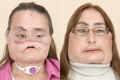 Connie Culp, antes y despus de su operacin, en 2008.