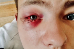 Elisey Fedin (19 aos), con rotura del prpado en el ojo.