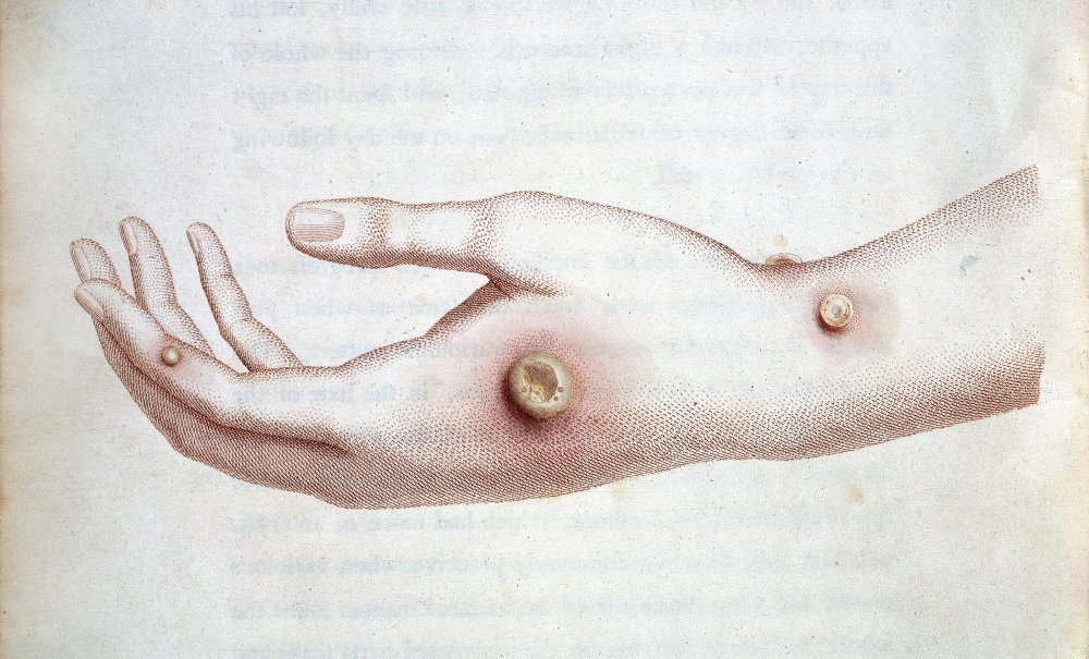 Lesiones de viruela en la piel
