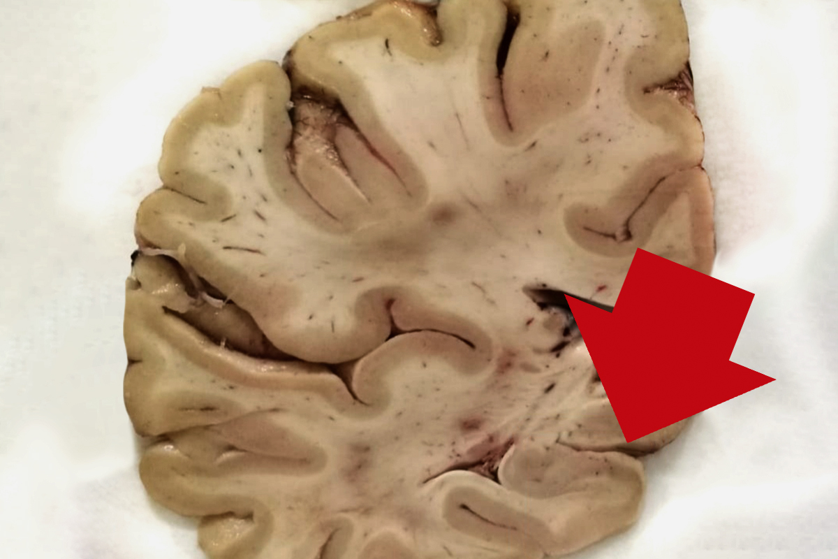 Zona inflamada de uno de los cerebros de la investigacin espaola