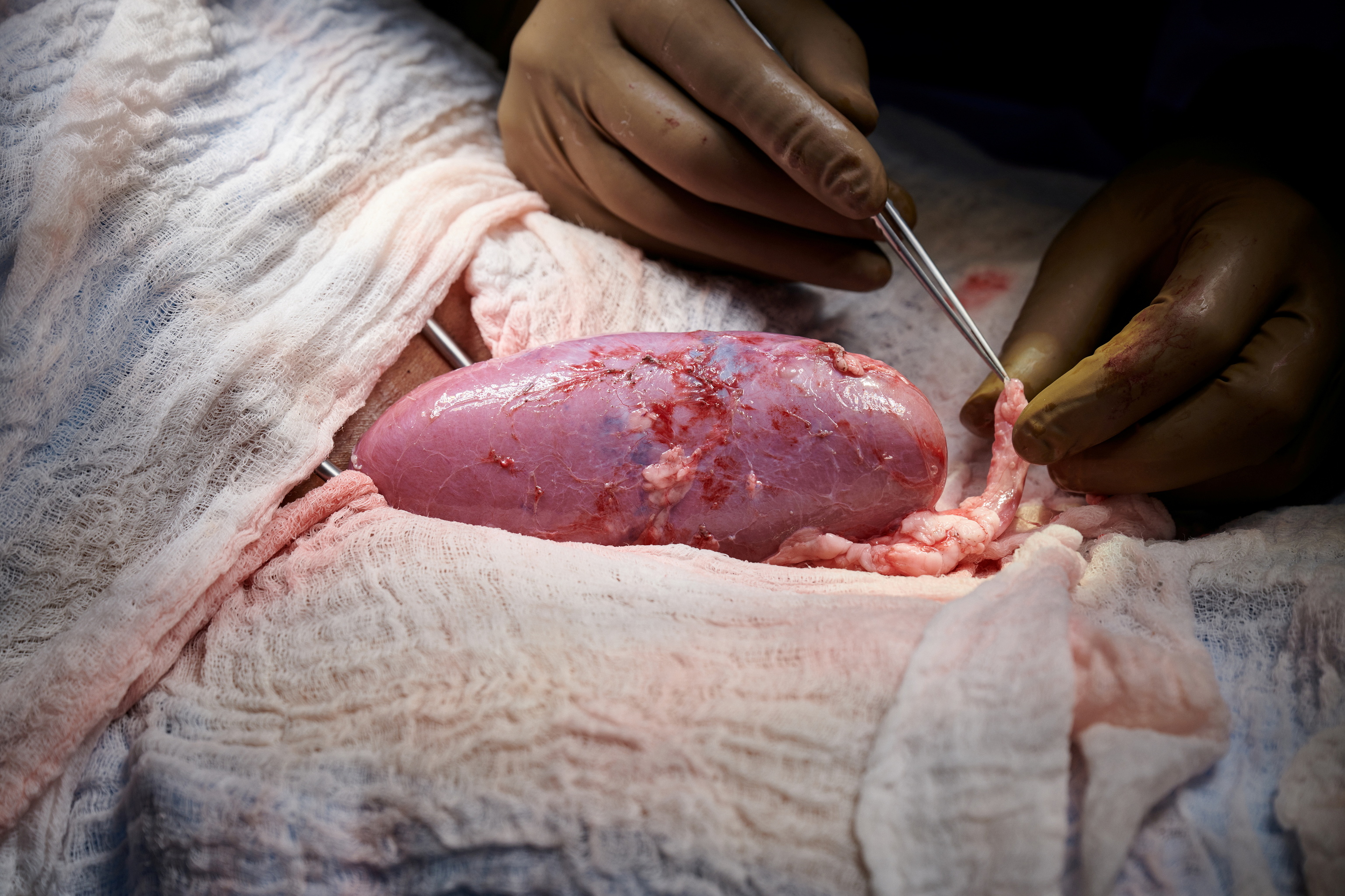 Un rin de cerdo modificado genticamente durante la operacin del trasplante.