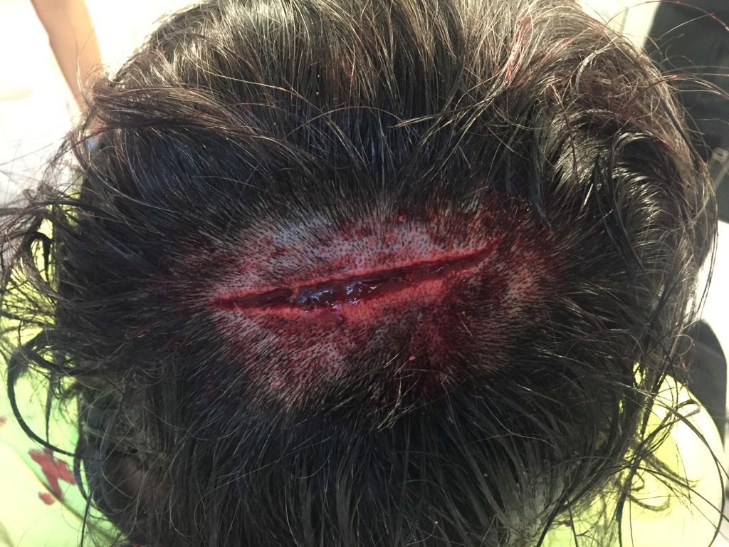 La herida en la cabeza del transportista atacado por los piquetes.