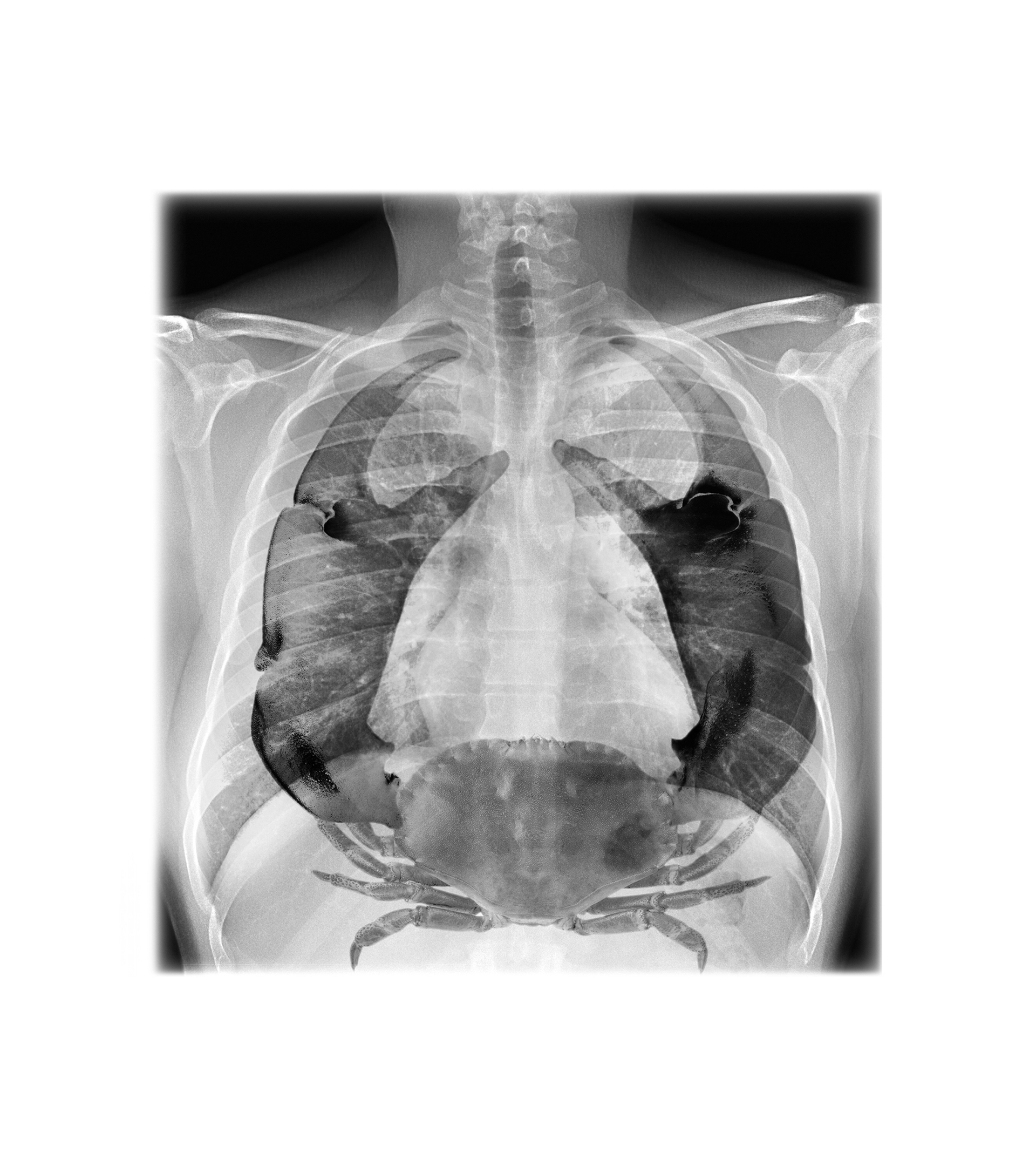 La amenaza engaosa del cncer de pulmn: no solo afecta a fumadores