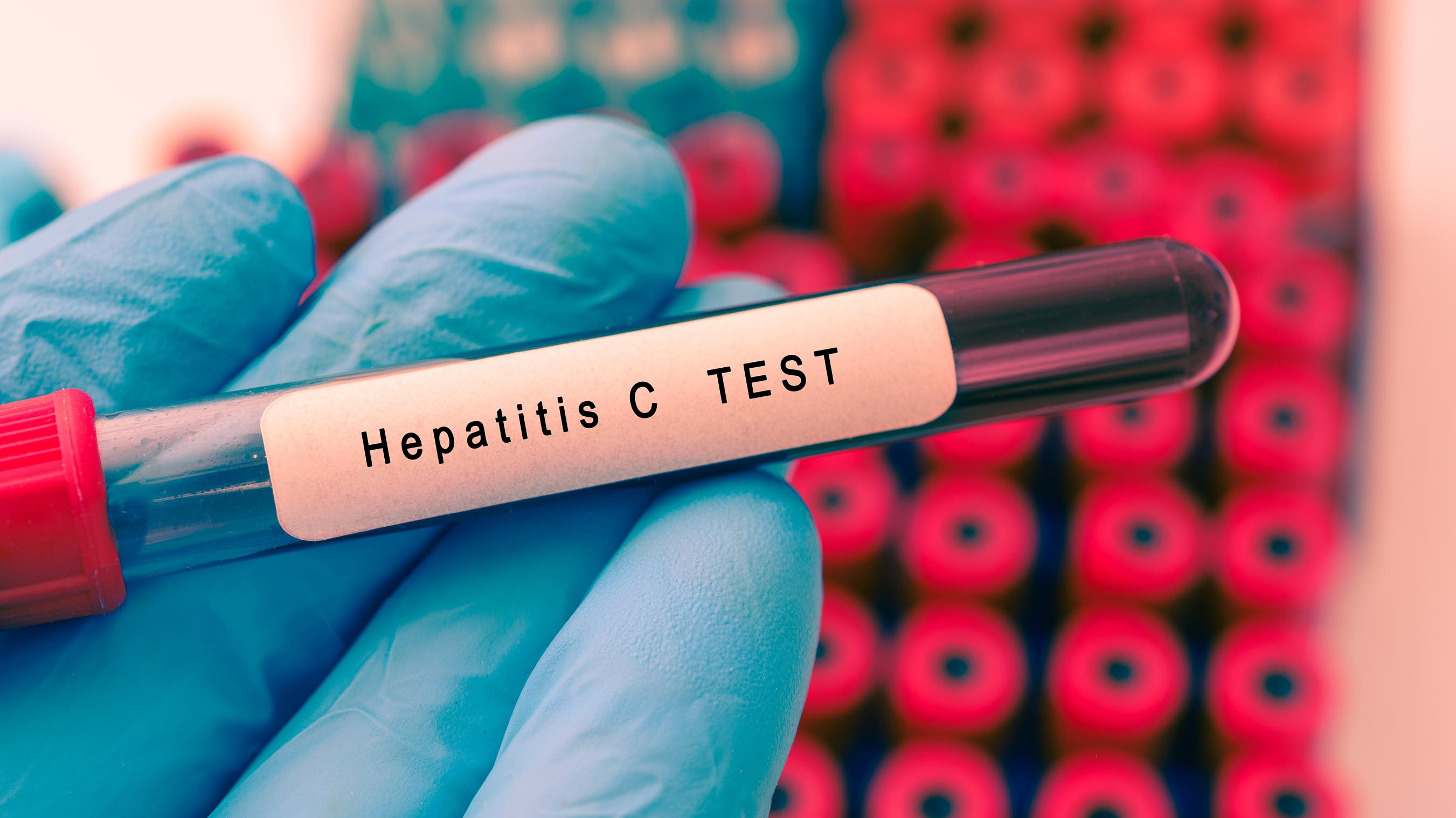 Sociedades Mdicas y AbbVie lanzan el Declogo para avanzar en la eliminacin de la hepatitis C