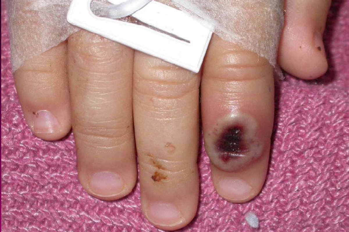 Fotografía del Centro Estadounidense de Control de las Enfermedades (CDC) en la que se aprecia el dedo de un niño infectado por la llamada viruela de mono.