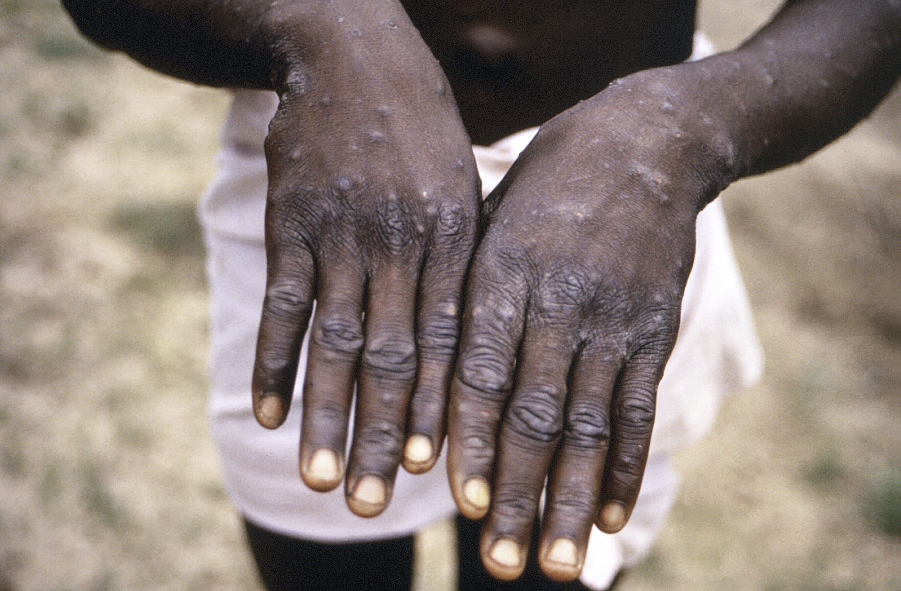 Primer plano de las manos de un paciente con viruela del mono durante un brote en la República Democrática del Congo entre 1996 y 1997.