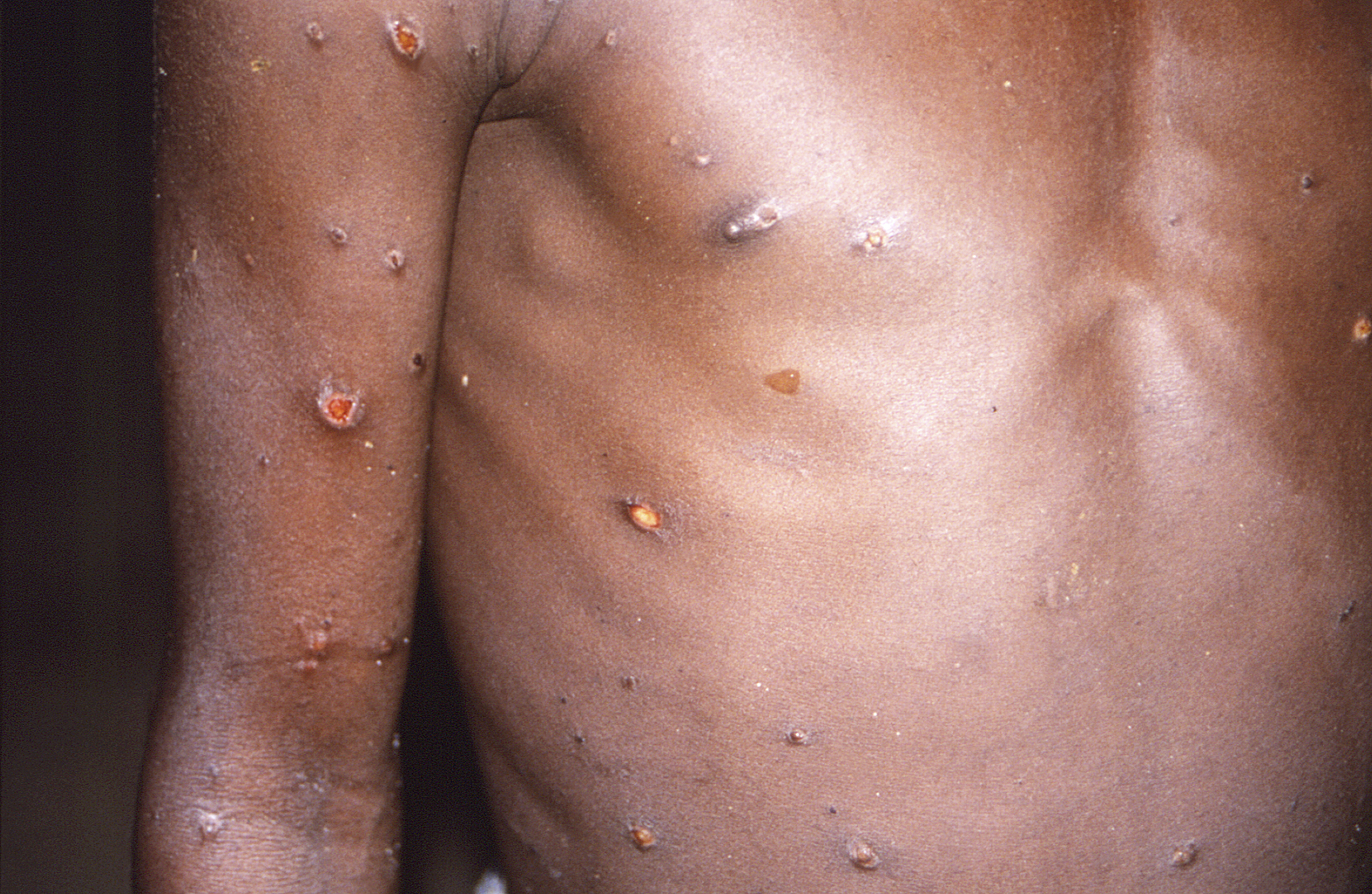 Image of the arm and torso of the patient, whose skin shows monkeypox lesions, in 1997.