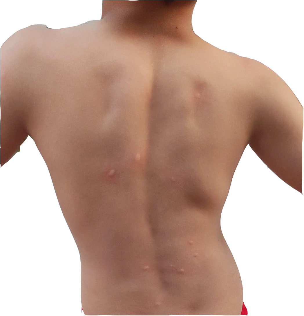 Espalda de un adolescente de Castelln tras las picaduras.