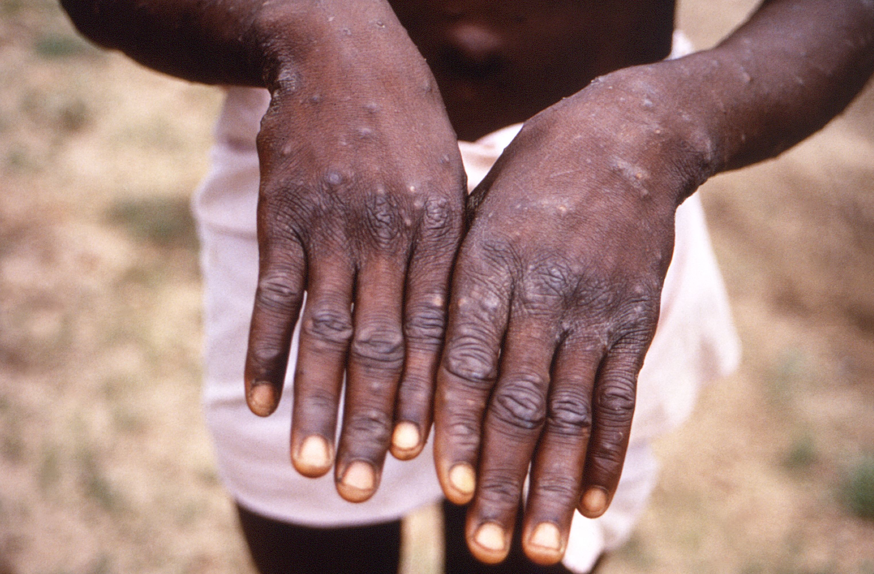 Signs of disease on the hand of the patient.