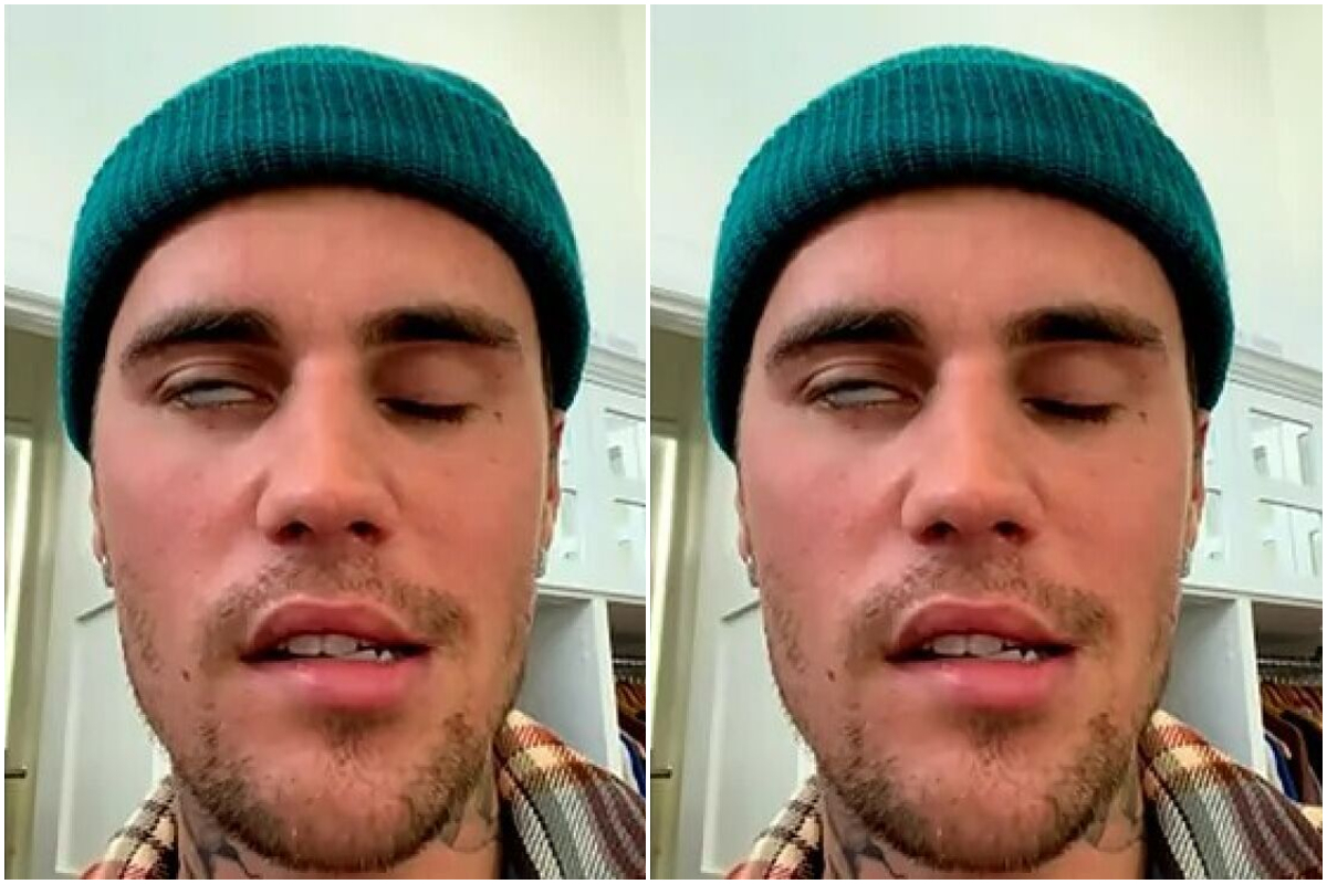 Justin Bieber afectado por el sndrome de Ramsay Hunt en una instantnea que el artista ha compartido en redes sociales.