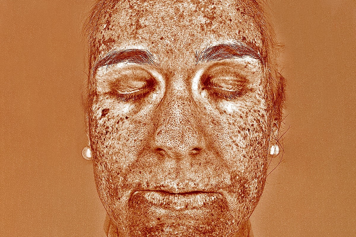 Imagen de un análisis de las capas profundas de la piel, realizado con Visia en el Centro Dermatológico Internacional.